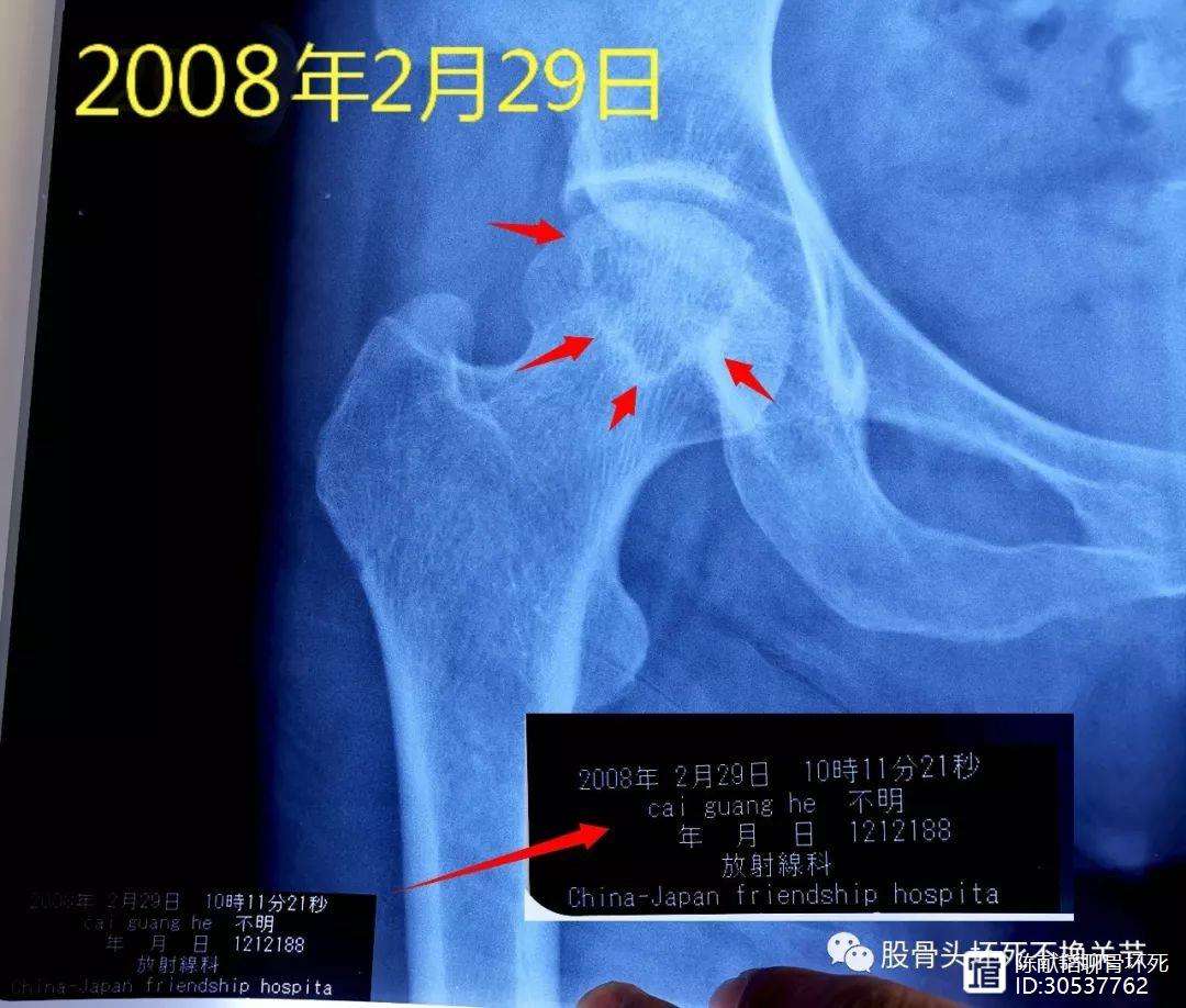 襄樊人工骨头医保报销多少(人工骨头医保报销多少比例)