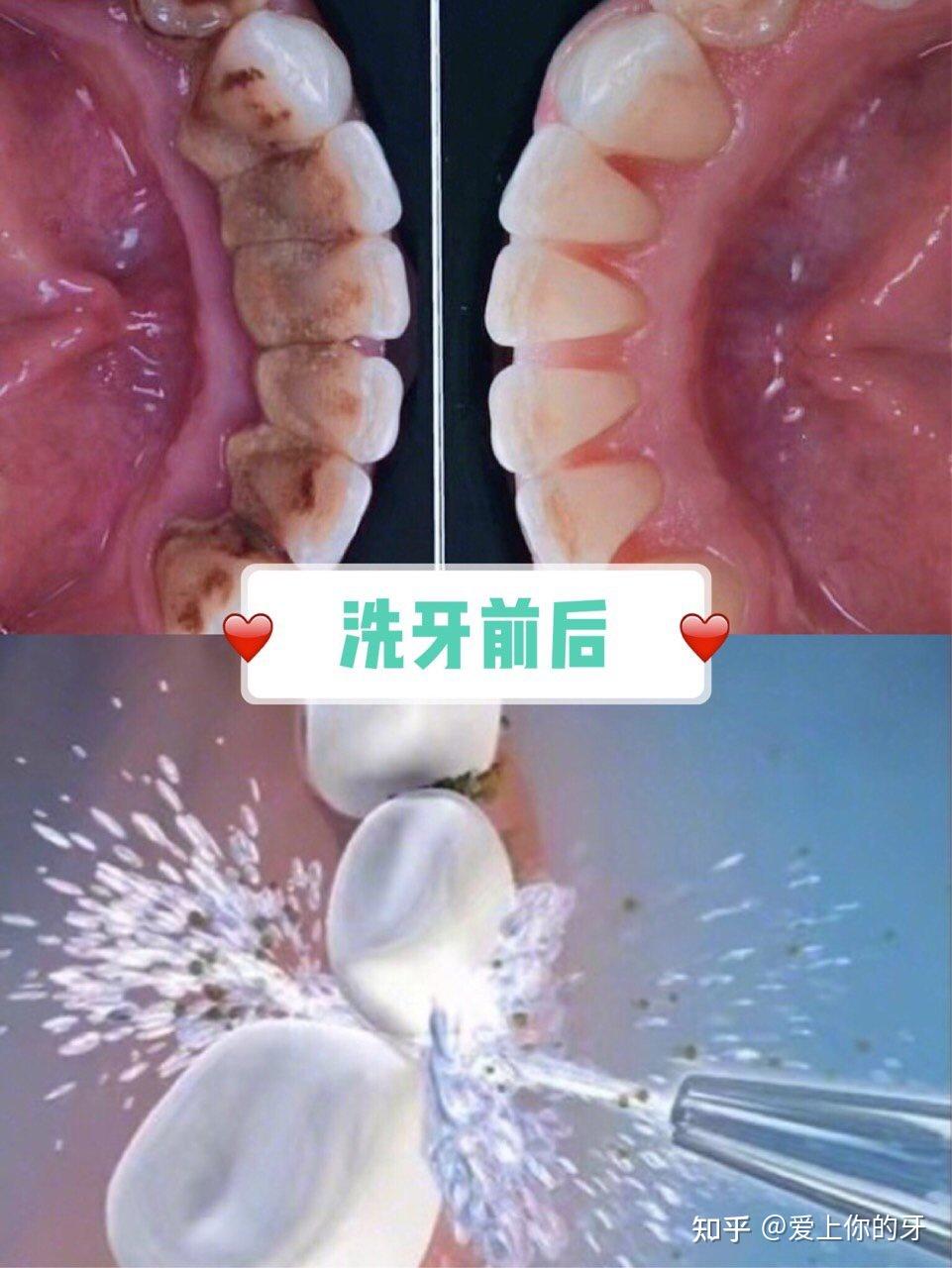 襄樊洗牙可以用医保吗(洗牙可以用医保吗,报销比例多少)